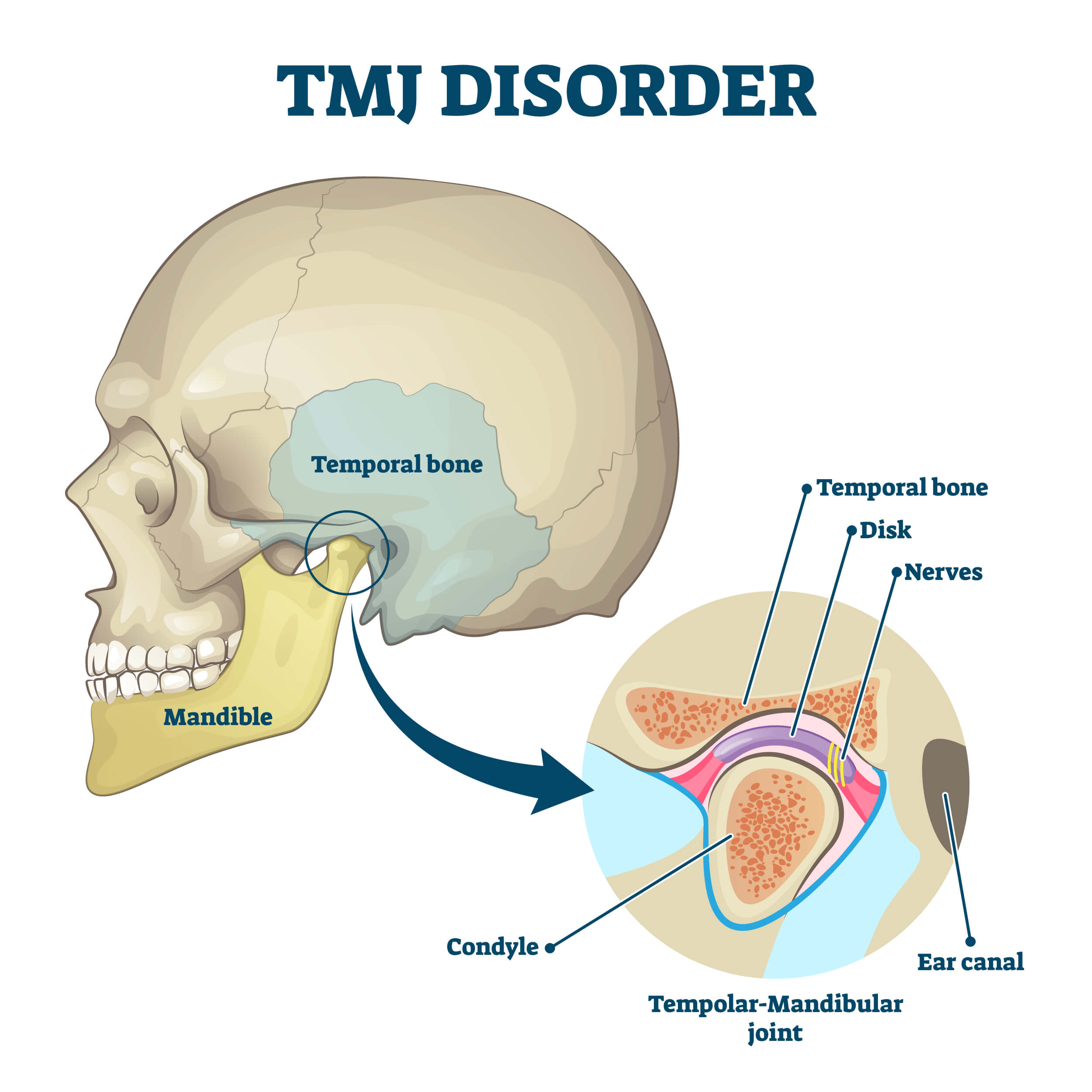 TMJ Disorder Diagram